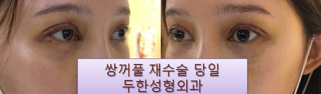 [두한성형외과 쌍커풀재수술] - [심한 소세지눈, 두줄따기, 쌍꺼풀 흉터] 관련 이미지 31