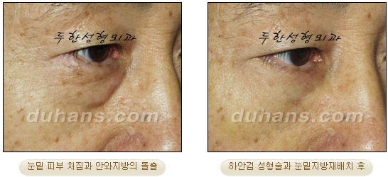 [Duhan Plastic Surgery Ophthalmic Plastic Surgery] - [Lower Blepharoplasty] image 22