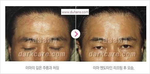[두한성형외과 경쟁력 주름성형] - [주름제거와 볼륨을 갖게하는 엔도타인 리프팅] 관련 이미지 26