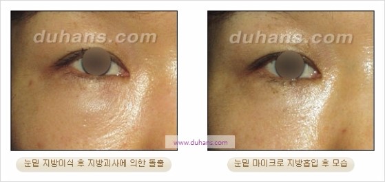 [두한성형외과 경쟁력 지방흡입] - [볼살, 턱선의 간편 지방흡입] 관련 이미지 28