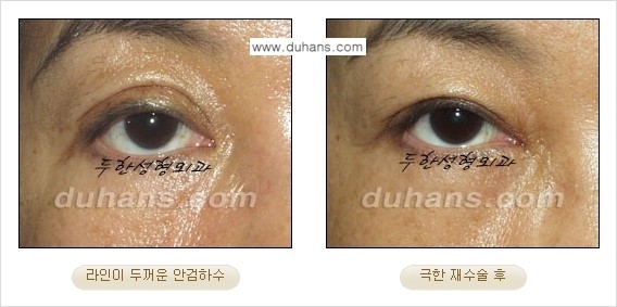 [두한성형외과 경쟁력 눈성형] - [두꺼운 라인을 교정하는 극한 눈 재수술 1.] 관련 이미지 10