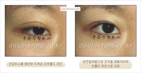 [두한성형외과 경쟁력 눈성형] - [완전절개법(Full incision method)의 재수술 과정] 관련 이미지 16