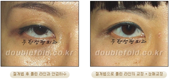 [Duhan Plastic Surgery Double Eyelid Revision Surgery] - [Ptosis Correction Surgery] image 53