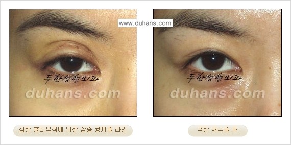 [두한성형외과 성형 FOCUS] - [정상적인 눈매로의 복원 극한재수술 경우 ②] 관련 이미지 7