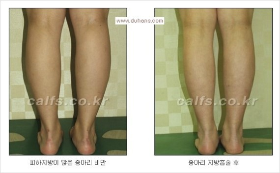 [두한성형외과 경쟁력 종아리성형 리더] - [종아리 성형 안내] 관련 이미지 11