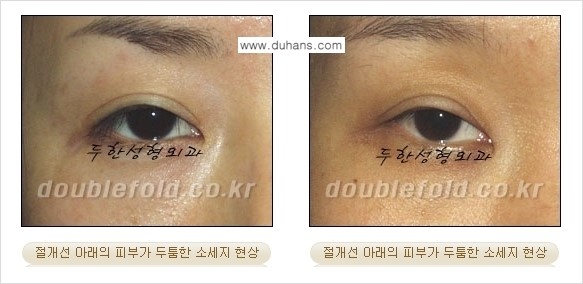 [두한성형외과 경쟁력 쌍꺼풀 재수술, 극한 재수술] - [쌍꺼풀 절개선 아래가 두툼한 소세지 쌍꺼풀의 교정 안내] 관련 이미지 1