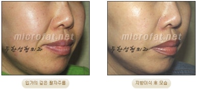 [Duhan Plastic Surgery Face Fat Grafting] - [Reducing Mouth Corners Wrinkles and Nasolabial Folds] image 21