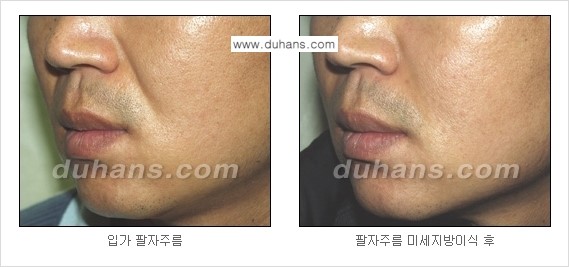 [두한성형외과 경쟁력 주름성형] - [미세지방이식을 이용한 주름교정 안내 - 눈밑주름, 입가주름, 팔자주름 2.] 관련 이미지 21