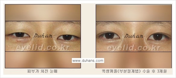 [두한성형외과 NO.1 눈성형] - [절개법과 매몰법 관련 흔한 질문과 답변] 관련 이미지 6