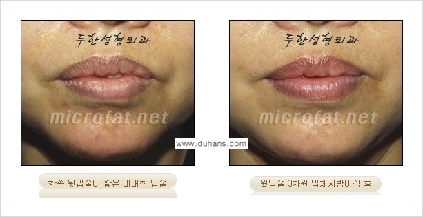[두한성형외과 경쟁력 미세지방이식] - [입술 미세지방이식 안내] 관련 이미지 4