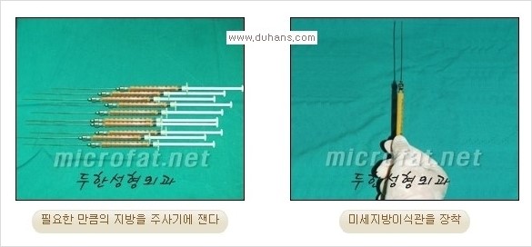 ​​​[두한성형외과 경쟁력 지방이식] - [지방이식을 이용한 입술성형 안내] 관련 이미지 6