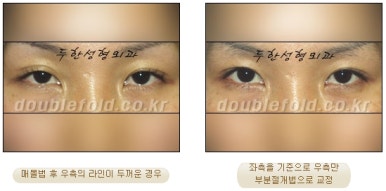 [Duhan Plastic Surgery Eye Surgery] - [Asymmetric Line, Eyelash Eversion, Deep Fixation] image 4