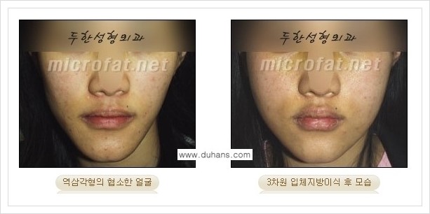⁠⁠[두한성형외과 경쟁력 볼살지방이식] - [심하게 야윈 주름이 있는 얼굴, 역삼각형 협소한 얼굴, 광대뼈가 돌출되어 보이는 경우 안내] 관련 이미지 14