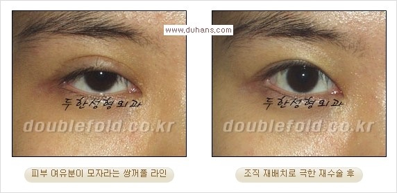 [두한성형외과 경쟁력 쌍꺼풀 재수술, 극한 재수술] - [쌍꺼풀 재수술에서 극복해야 할 극한의 상황과 문제들] 관련 이미지 12