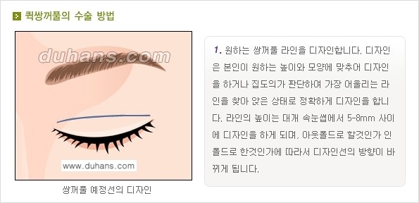 [두한성형외과 경쟁력 눈성형]- [최소 부기로 일상의로의 복귀가 가능한 아름다운 퀵쌍꺼풀(부분절개법) 수술] 관련 이미지 1