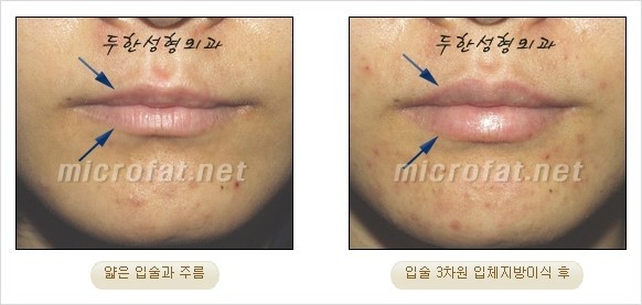 [두한성형외과 경쟁력 지방이식 리더] - [Col-fat(콜펫)지방이식, 3차원 입체지방이식, 2차원 평면지방이식] 관련 이미지 36