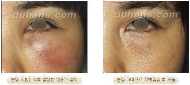 [두한성형외과 안전한 지방흡입] - [얼굴지방흡입] 관련 이미지 15