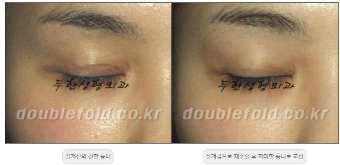 [Double Eyelid Surgery Duhan Plastic Surgery] - [Revision Methods] image 43