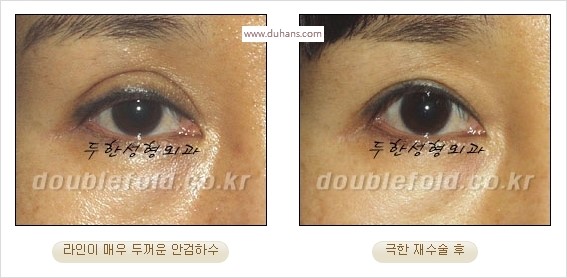 [두한성형외과 경쟁력 쌍꺼풀 재수술 스페셜] - [망가진 라인을 교정하는 극한 재수술] 관련 이미지 25