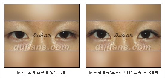 [두한성형외과 쌍커풀수술] - [눈성형 방법에 대한 자주하는 질문과 답변] 관련 이미지 123