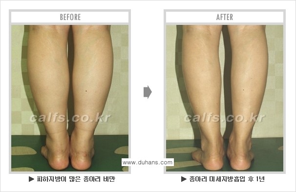 [두한성형외과 매력적인 종아리 만들기!] - [정교한 흡입 - 미세흡입관 지방흡입술 3.] 관련 이미지 6