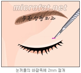 [두한성형외과 지방제거] - [눈밑지방제거, 윗눈꺼풀지방제거] 관련 이미지 55