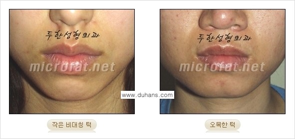 [두한성형외과 경쟁력 미세지방이식] - [부드럽고 아름다운 얼굴윤곽선 턱(하악부) 미세지방이식 안내] 관련 이미지 1