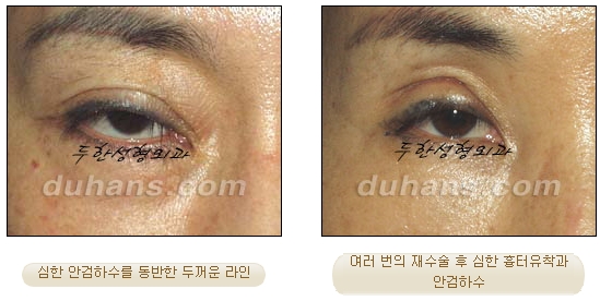 [Special Double Eyelid Revision Surgery at Duhan Plastic Surgery] - [Restorative Surgery for Damaged Double Eyelid Eye Shape] image 2
