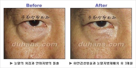 [두한성형외과 경쟁력 동안성형 리더] - ​[미간주름, 이마주름, 안검성형, 이마거상술, 눈썹거상술] 관련 이미지 72