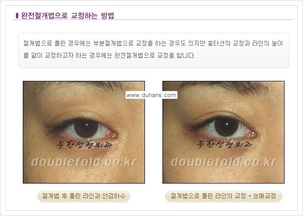 [두한성형외과 경쟁력 쌍꺼풀(눈) 재수술] - [풀린 쌍꺼풀 절개법으로 교정하는 방법 안내] 관련 이미지 1