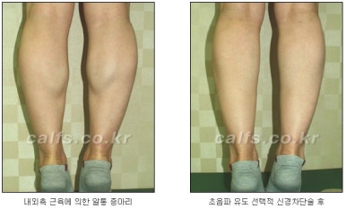​[두한성형외과 종아리수술] - [나에게 맞는 종아리성형방법] 관련 이미지 8