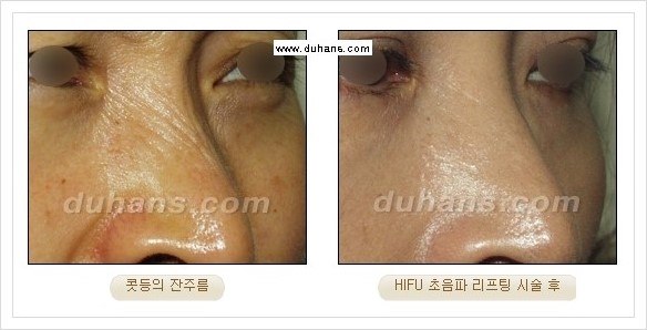 [두한성형외과 경쟁력 주름성형] - [HIFU 초음파 리프팅 주름교정술 안내 2.] 관련 이미지 20