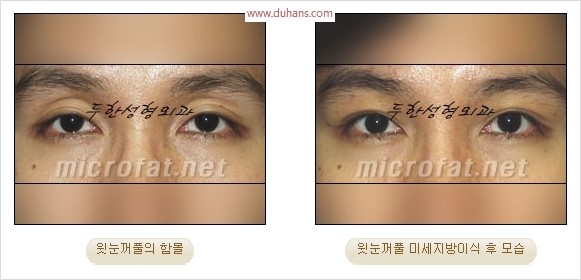 [두한성형외과 경쟁력 눈성형 리더] - [윗눈꺼풀 함몰( #꺼진눈꺼풀) 미세지방이식과 상안검성형]#꺼진눈성형 , #눈위함몰 관련 이미지 21
