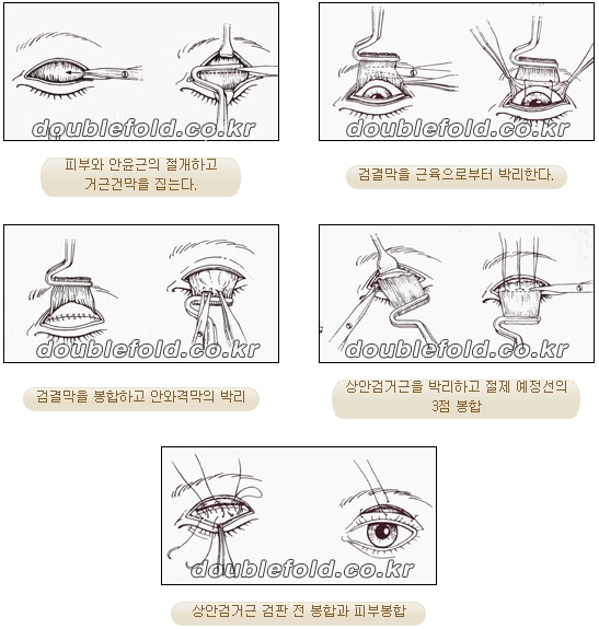 과교정 눈매 (소세지 쌍커풀 재수술, 눈매교정 재수술) 관련 이미지 15