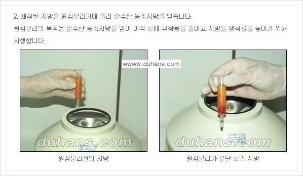 ​[두한성형외과 경쟁력 주름성형] - [주름교정을 위한 미세지방이식 안내 1.] 관련 이미지 8