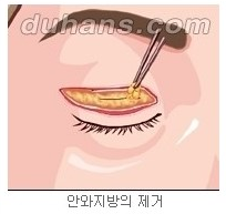 [두한성형외과 안검성형] - [상안검, 하안검] 관련 이미지 5