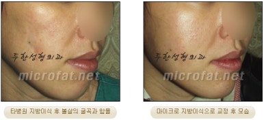 [두한성형외과 얼굴지방이식] - [볼지방이식] 관련 이미지 40