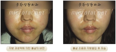 Facial Fat Liposuction at Duhan Plastic Surgery - Cheek Fat Liposuction, Jawline Liposuction, Under-Eye Fat Liposuction image 16
