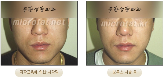 [두한성형외과 보톡스] - [사각턱 보톡스 시술 안내] 관련 이미지 19