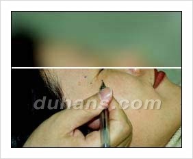 ​[두한성형외과 안티에이징] - [보톡스, 필러, 지방이식을 이용한 주름개선] 관련 이미지 2