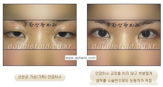 [두한성형외과 경쟁력 눈성형] - [안검하수(졸리운 눈매)의 종류와 교정 방법 안내] 관련 이미지 4
