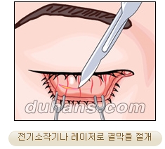 두한성형외과 지방제거 - 눈밑지방, 눈꺼풀지방제거 관련 이미지 15