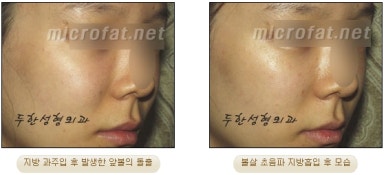 Facial Fat Liposuction at Duhan Plastic Surgery - Cheek Fat Liposuction, Jawline Liposuction, Under-Eye Fat Liposuction image 29