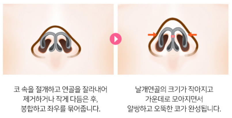 [디바성형외과] 복코코끝성형 세련되고 날렵한 이미지로! 관련 이미지 5