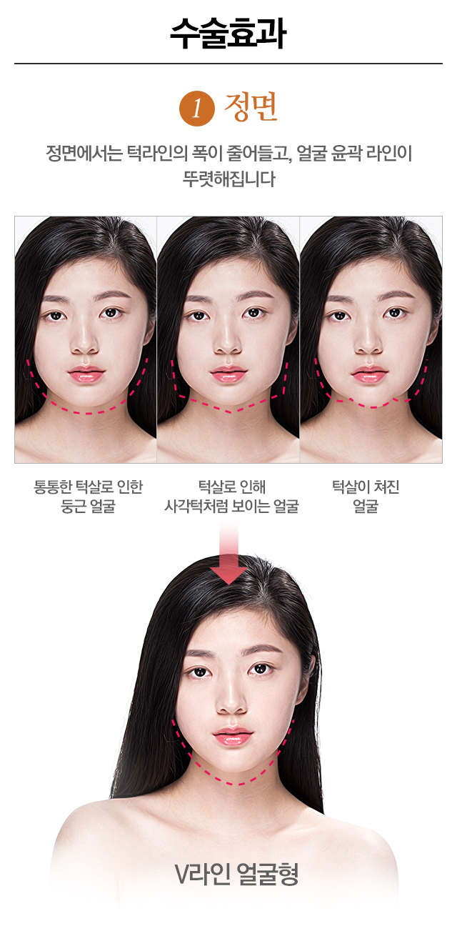이중턱제거 한방에 해결! 관련 이미지 2