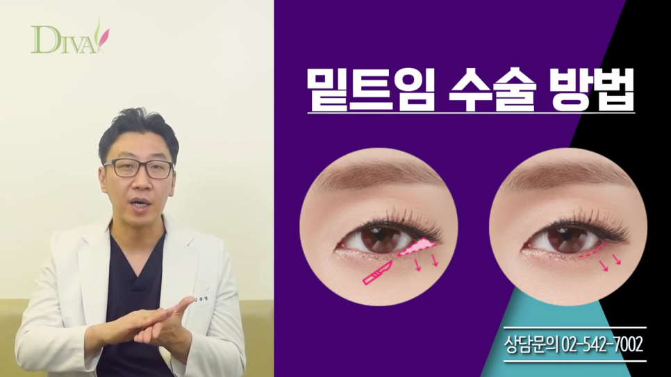 뒷트임 고민된다면 관련 이미지 5