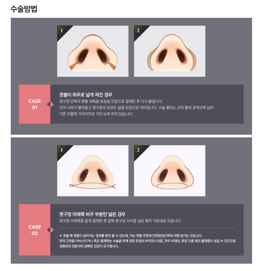 복코수술 세련된 라인으로 완성! 관련 이미지 5