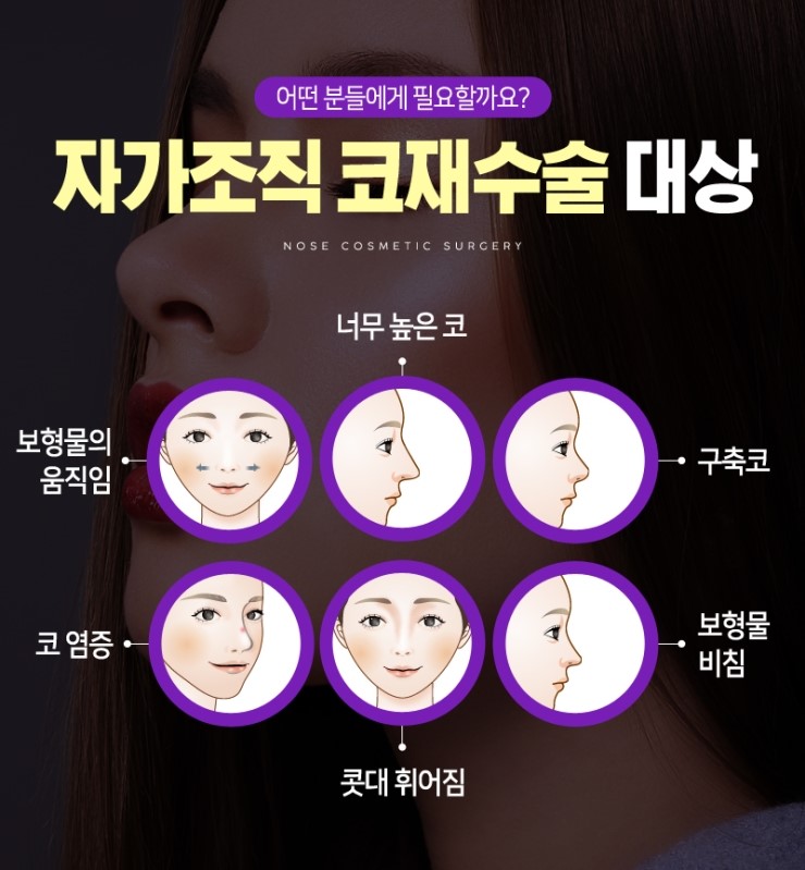 코재수술, 성공하기 위해서 알아야하는 체크사항 관련 이미지 6