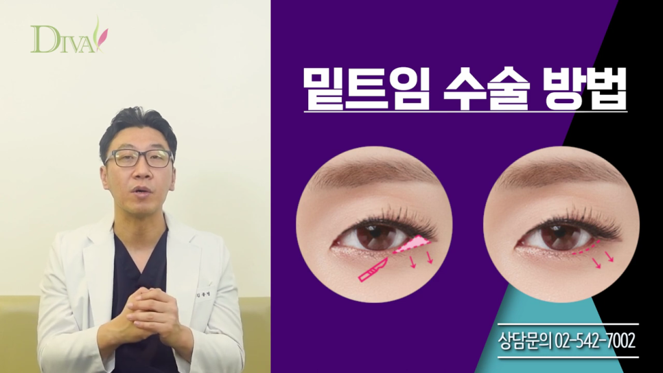 중년눈매교정 필요한 이유는 관련 이미지 5