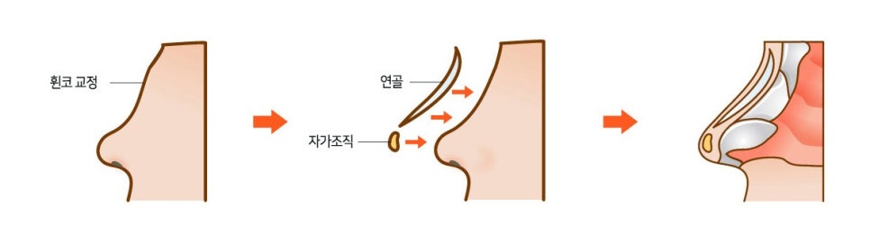 매부리코성형수술, 매부리코의 형태 및 특성별 적합한 교정수술 방법을 확인해 보자. 관련 이미지 2